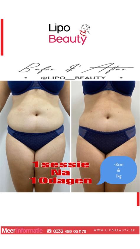 Photos D Avant Et Apr S Le Gel Des Lipo Beauty