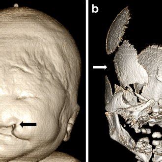 Postmortem Skeletal Radiograph A And D Postmortem Ct