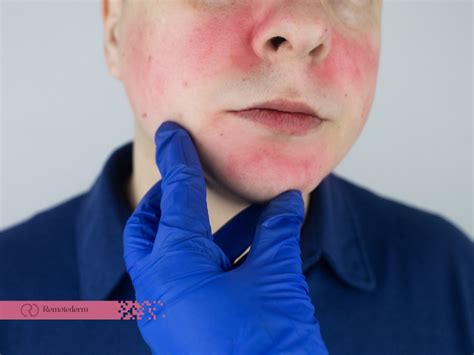 Comprehensive Guide To Mild Rosacea Remotederm