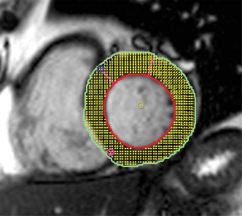 Feature Tracking Of Global Longitudinal Strain By Using Cardiovascular