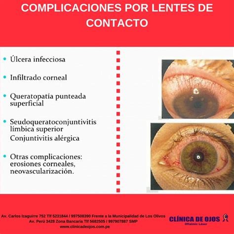 Clínica de Ojos Oftalmic Láser COMPLICACIONES POR LENTES DE CONTACTO