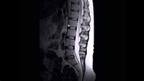 MRI Of Bulging Disc Lower Lumbar