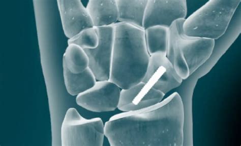 Scaphoid Fracture Surgery Open Reduction And Internal Fixation Orif