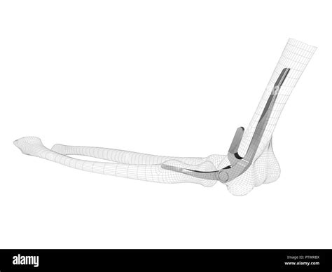 Schultergelenk Implantat D Ausgeschnittene Stockfotos Und Bilder Alamy