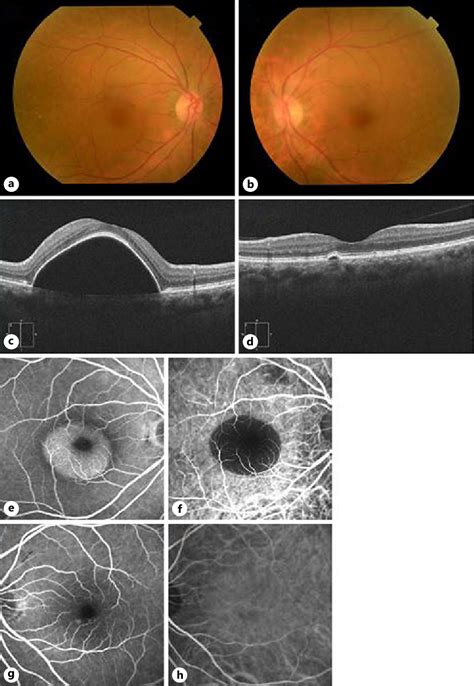 Figure 1 From Retinal Pigment Epithelial Detachment Associated With