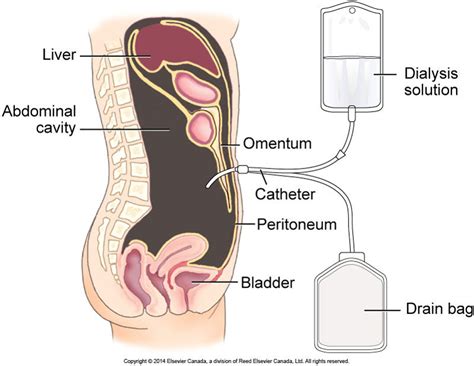 Peritoneal Dialysis Renal Replacement Therapies Libguides At Health Science Information