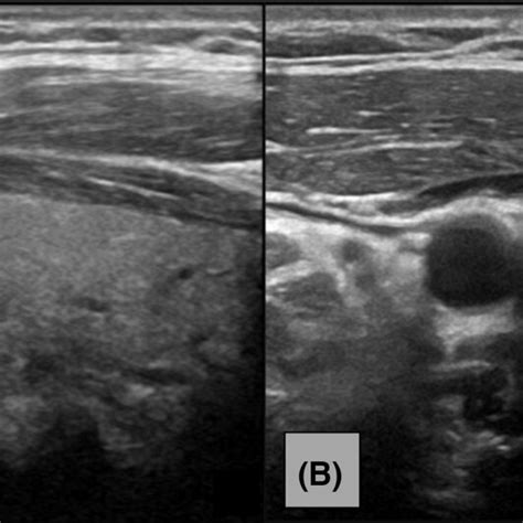 A Long‐axis Ultrasound Image Of The Right Thyroid Lobe Demonstrates A