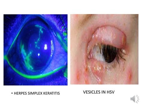 Viral Conjunctivitis Dr Arnav Ppt