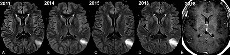 A Year Old Male With Oligodendroglioma Who Grade Ii Idh Mutant