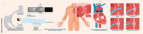 Cath Lab Atrial Septal Defect Tetralogy Of Fallot Patent Foramen Ovale