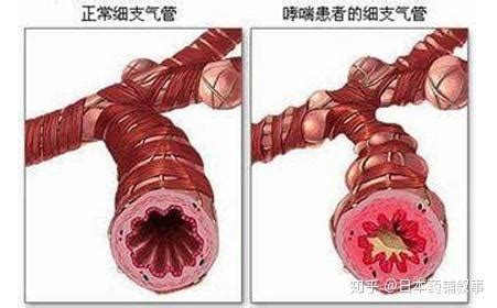 支气管哮喘慢性支气管炎怎么预防治疗 及日本杏林哮喘药介绍 知乎