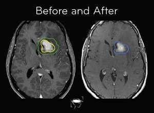 Brain Tumor Types Glioblastoma Meningioma More