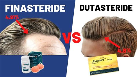 Dutasteride Vs Finasteride Which Is Better For Your Hair Growth