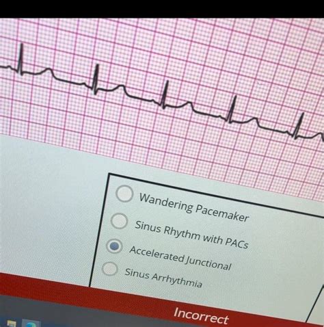 Solved Junctional Tachycardia Supraventricular Tachycardia | Chegg.com