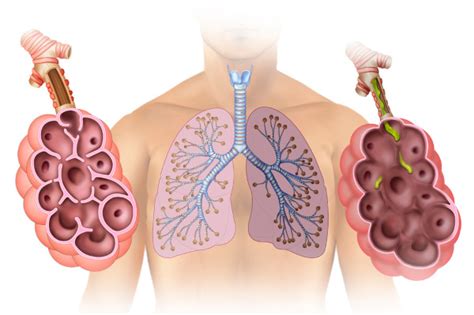 Alvéolos pulmonares o que são estrutura função Brasil Escola