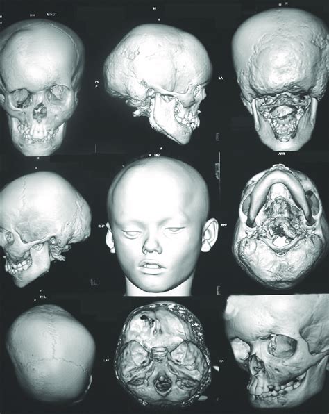 Computed Tomography Scan Shows Deformation Of The Cranial And Facial