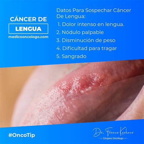 Datos Para Sospechar Cáncer De Lengua Dr Franco Krakaur Cirujano Oncólogo