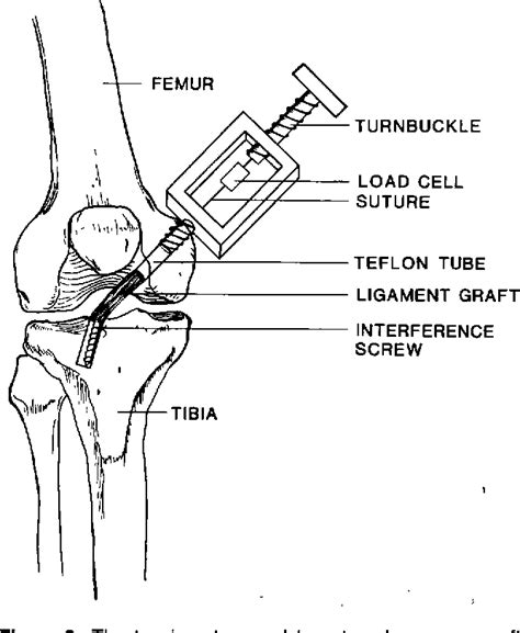 Figure 3 From The Effect Of Femoral Tunnel Position And Graft Tensioning Technique On Posterior