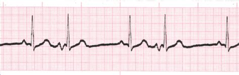 EKG EXAM 1 REVIEW Flashcards Quizlet