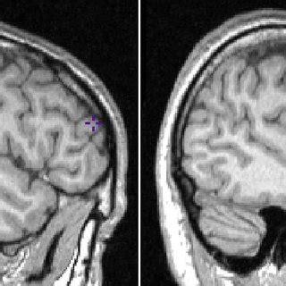 The inferior most aspect of the rostrum of the corpus callosum ...