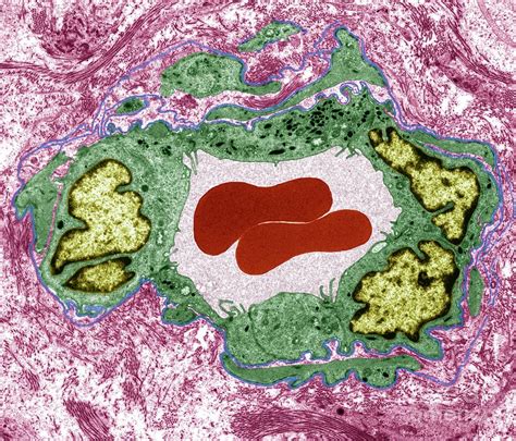 Testicular Cancer Capillary Photograph By Steve Gschmeissner Science