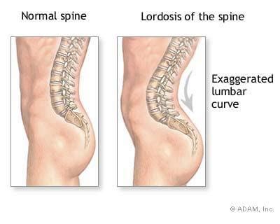 Lumbar Lordosis A Guide On Treatment Prevention Diagnosis