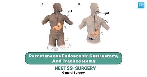 Percutaneous Endoscopic Gastrostomy And Tracheostomy