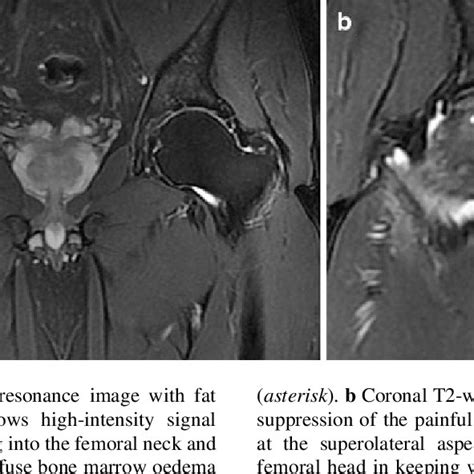 Pdf Transient Osteoporosis Of The Hip And Spontaneous Osteonecrosis