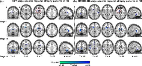 Progressive Patterns Of Stagespecific Gray Matter Atrophy In Patients