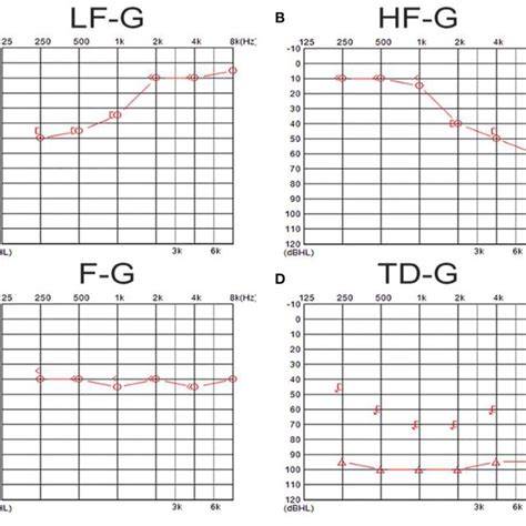 The Examples Of Audiograms In Four Types Of Uissnhl A Shows An Download Scientific Diagram