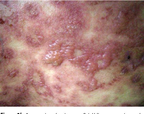 Table 1 From Severe Cutaneous Adverse Drug Reactions Stevens Johnson