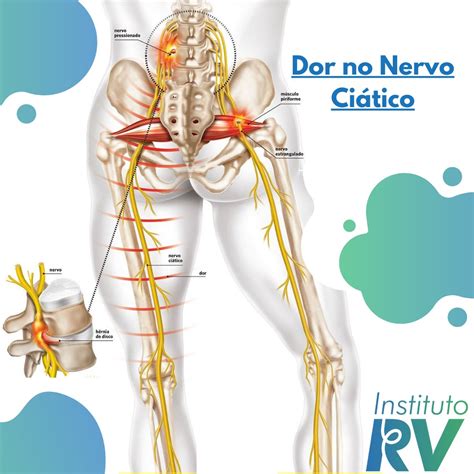 Nervo ciático e ciatalgia Entenda nosso tratamento Instituto RV