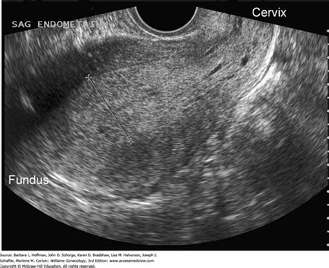 Making The Diagnosis With Endometrial Hyperplasia 59 OFF