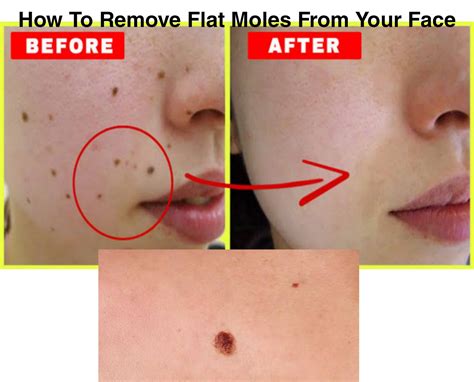 How To Remove Flat Moles From Face At Home Naturally