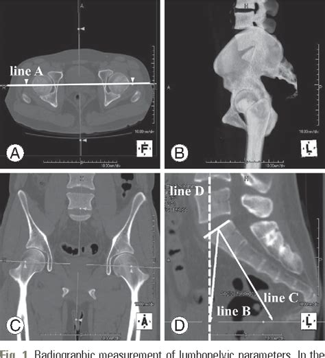 Figure 1 from Vacuum Phenomenon of the Sacroiliac Joint: Correlation with Sacropelvic Morphology ...