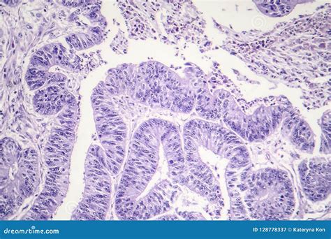 Carcinoma De Células Escamosas Del Esófago Imagen de archivo Imagen