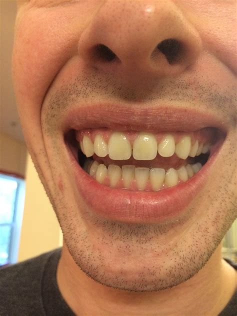 Can this gap be fixed with a retainer or bonding? : r/Dentistry