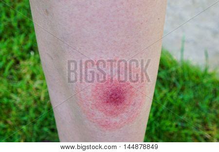 Lyme Disease, Image & Photo (Free Trial) | Bigstock