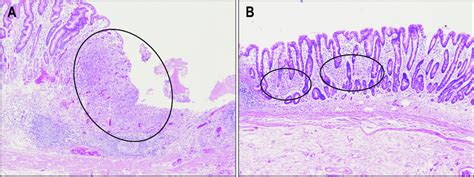 Signet Ring Cell Carcinoma Intramucosal Spreading Types Expansive