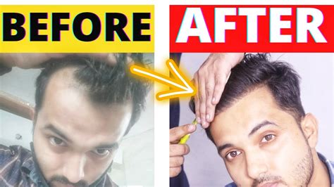 My 4 Months Hair Transplant Result Timeline Getting Natural Hairline