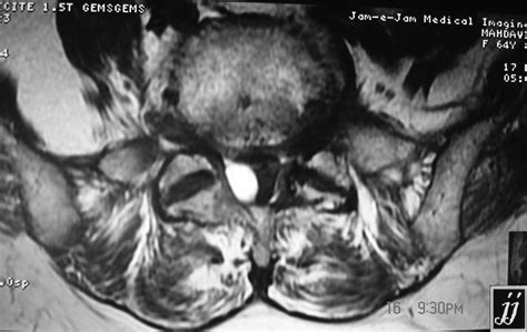 Intradural extramedullary tumor – Radiopaedia