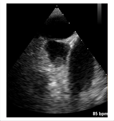 Transesophageal Echocardiogram Showing A Mildly Dilated Left Atrium