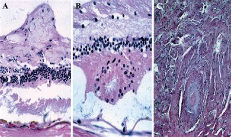 Other NF2 -associated lesions. (A) Retinal tuft arising from the nerve ...