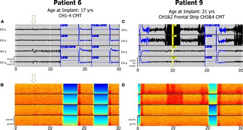 Frontiers Responsive Neurostimulation Targeting The Anterior