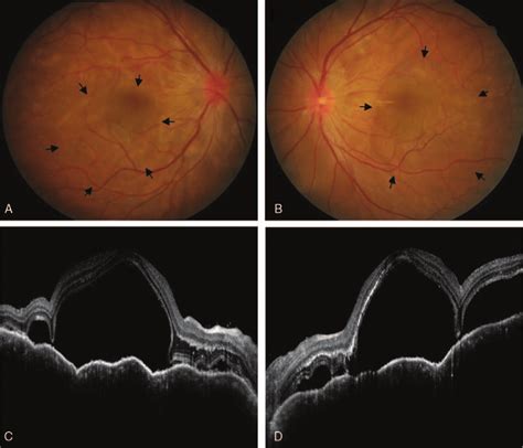 Fundus Photography And Optical Coherence Tomography Oct Of Both Eyes