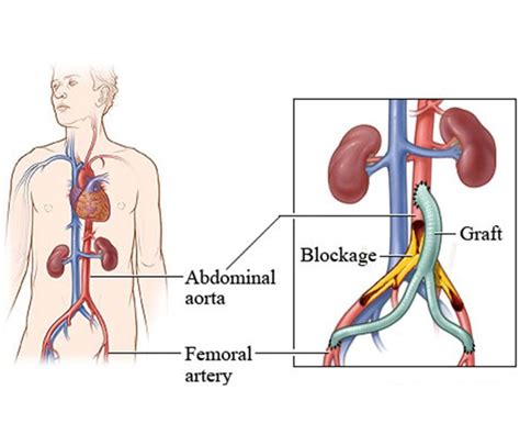 Revitalizing Aortobifemoral Bypass Surgery