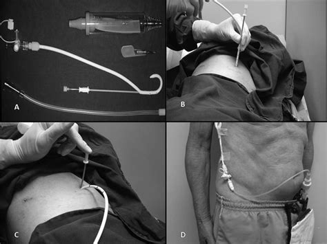 A Pigtail Catheter And Heimlich Valve B And C Catheter Insertion