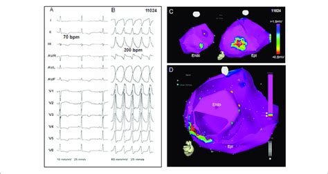 Electroanatomic Mapping In Patients With Sustained Ventricular