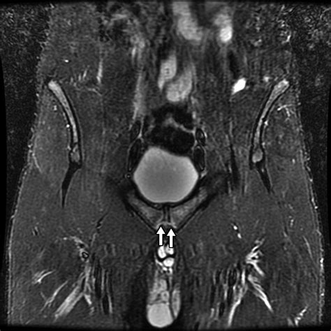 The Role Of Pubic Symphyseal CT Arthrography In The Imaging Of Athletic