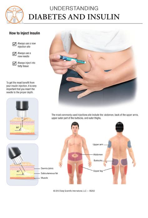 Diabetes And Insulin Anatomical Wall Chart Bsi Catalog